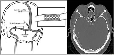 Transverse Sinus Stenting Reverses Medically Refractory Idiopathic Intracranial Hypertension
